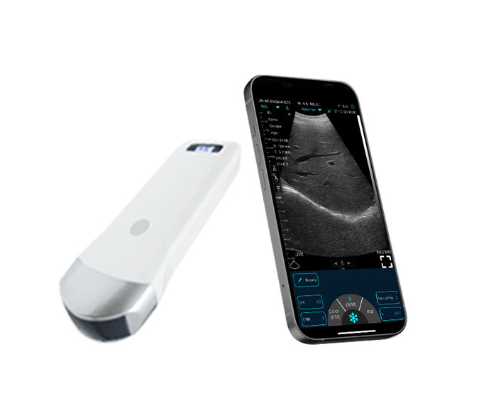 handheld ultrasound