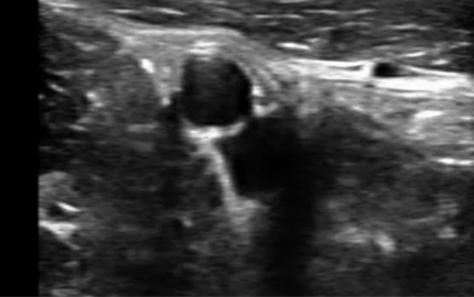 腹部超音波トランスデューサーイリアック動脈B